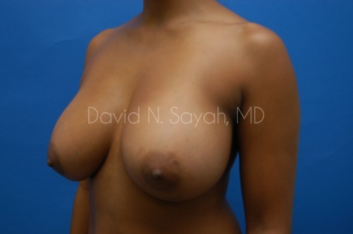 Breast Augmentation Before and After | Sayah Institute