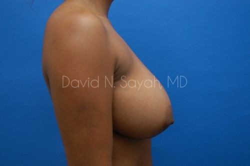 Breast Augmentation Before and After | Sayah Institute