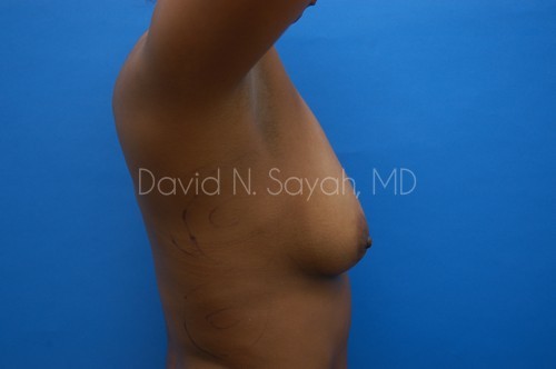 Breast Augmentation Before and After | Sayah Institute