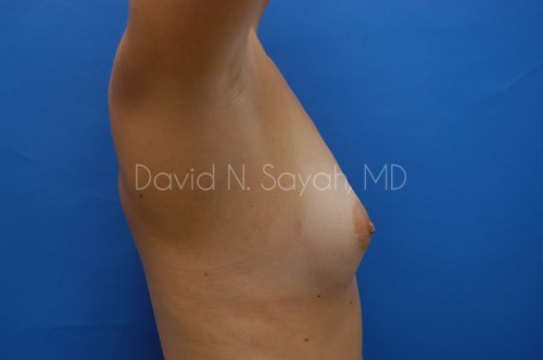 Breast Augmentation Before and After | Sayah Institute