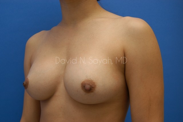 Breast Augmentation Before and After | Sayah Institute