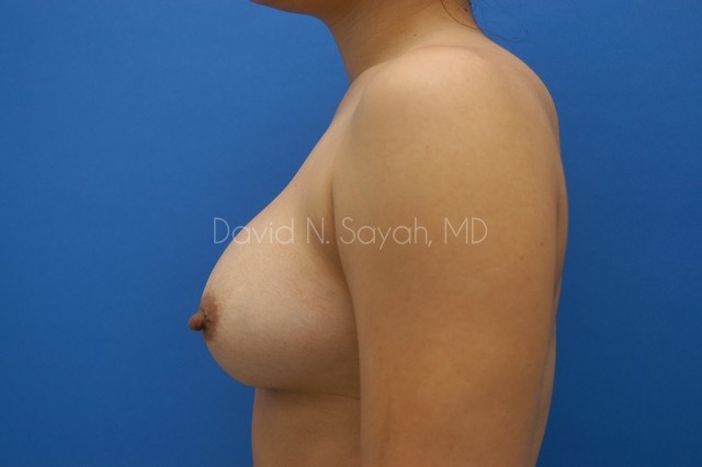 Breast Augmentation Before and After | Sayah Institute
