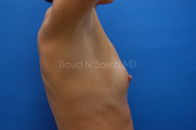 Breast Augmentation Before and After | Sayah Institute