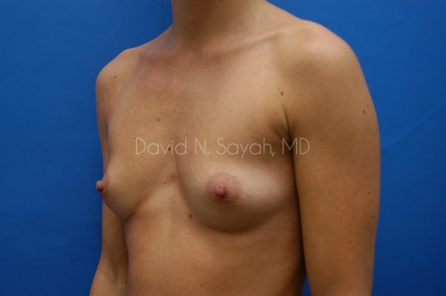 Breast Augmentation Before and After | Sayah Institute
