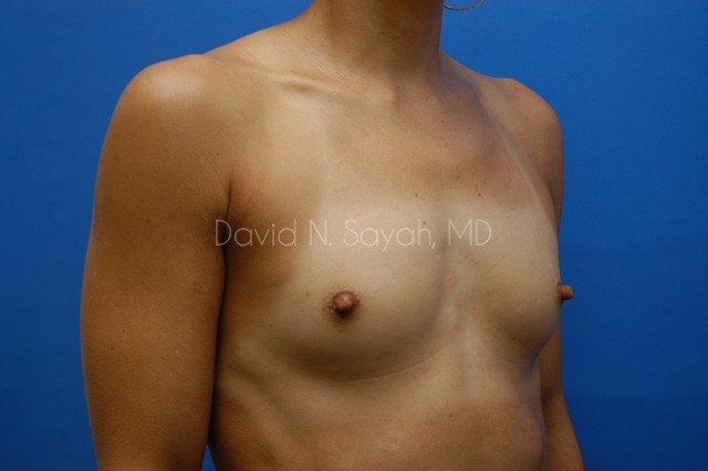 Breast Augmentation Before and After | Sayah Institute