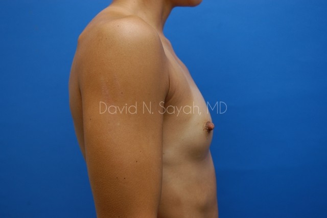 Breast Augmentation Before and After | Sayah Institute