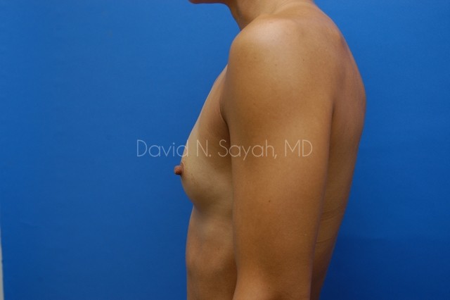 Breast Augmentation Before and After | Sayah Institute