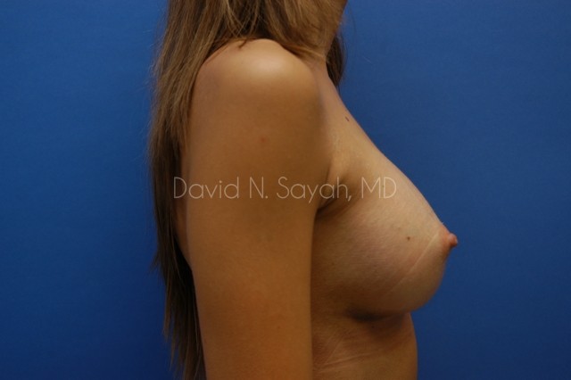 Breast Augmentation Before and After | Sayah Institute