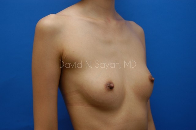 Breast Augmentation Before and After | Sayah Institute
