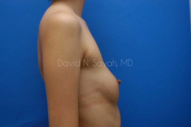 Breast Augmentation Before and After | Sayah Institute