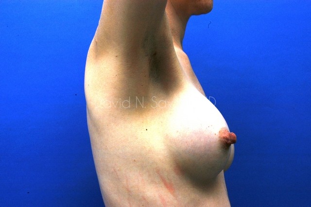 Breast Augmentation Before and After | Sayah Institute