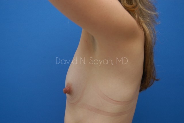 Breast Augmentation Before and After | Sayah Institute