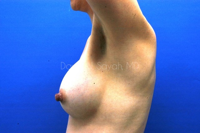 Breast Augmentation Before and After | Sayah Institute
