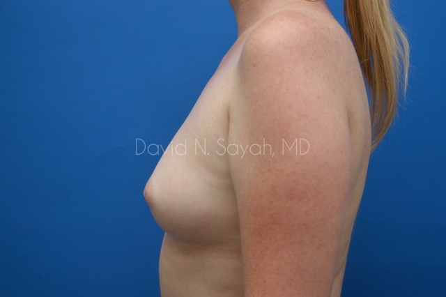 Breast Augmentation Before and After | Sayah Institute
