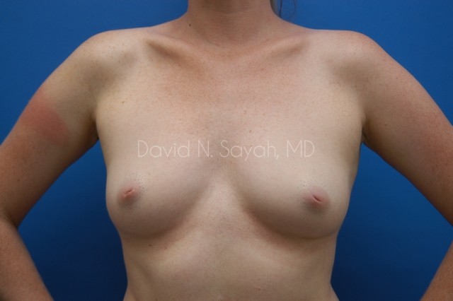Breast Augmentation Before and After | Sayah Institute