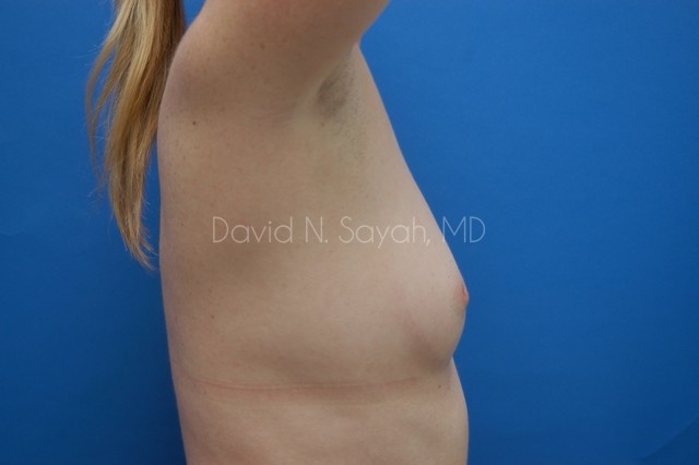 Breast Augmentation Before and After | Sayah Institute