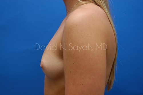 Breast Augmentation Before and After | Sayah Institute