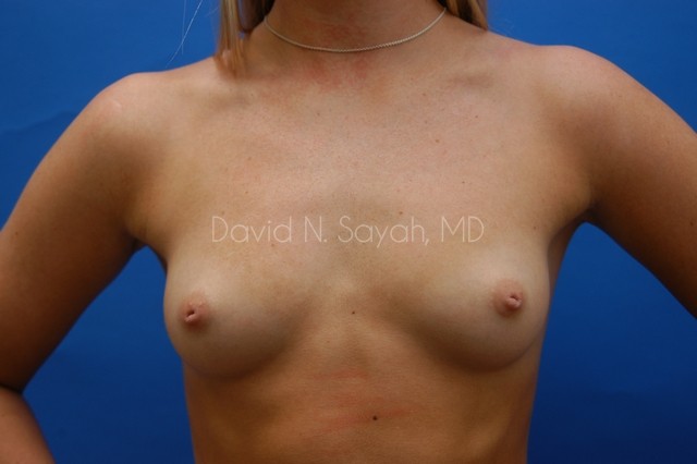 Breast Augmentation Before and After | Sayah Institute