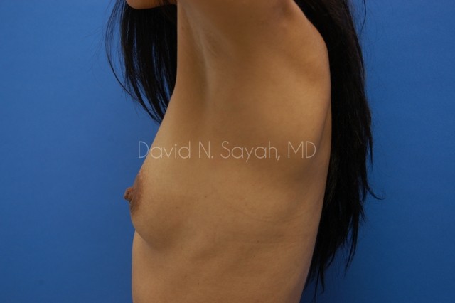 Breast Augmentation Before and After | Sayah Institute