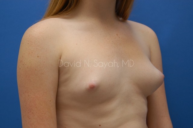 Breast Augmentation Before and After | Sayah Institute