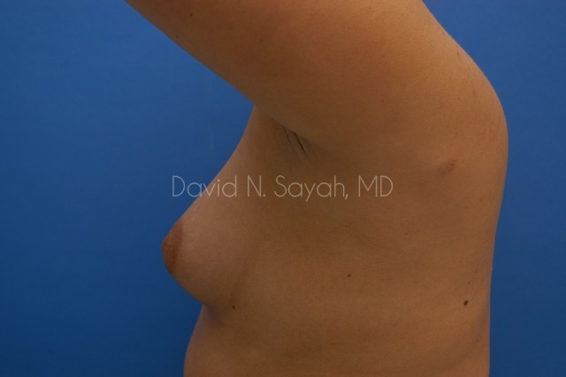 Breast Augmentation Before and After | Sayah Institute