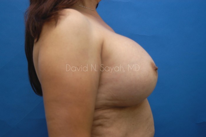 Breast Implant Exchange Before and After | Sayah Institute