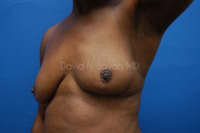 Breast Implant Exchange Before and After | Sayah Institute