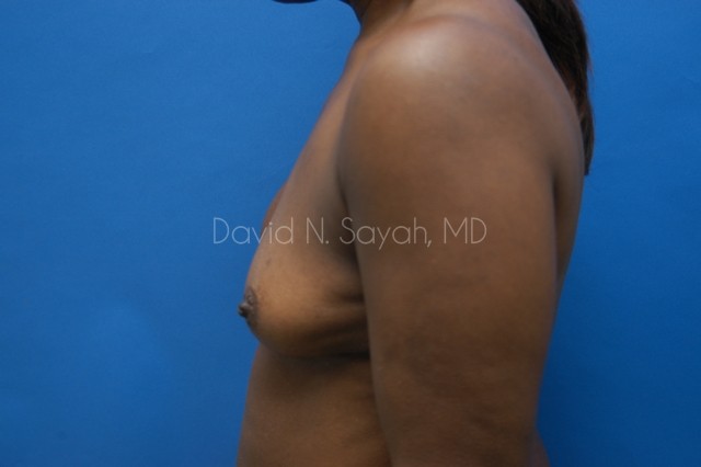 Breast Implant Exchange Before and After | Sayah Institute
