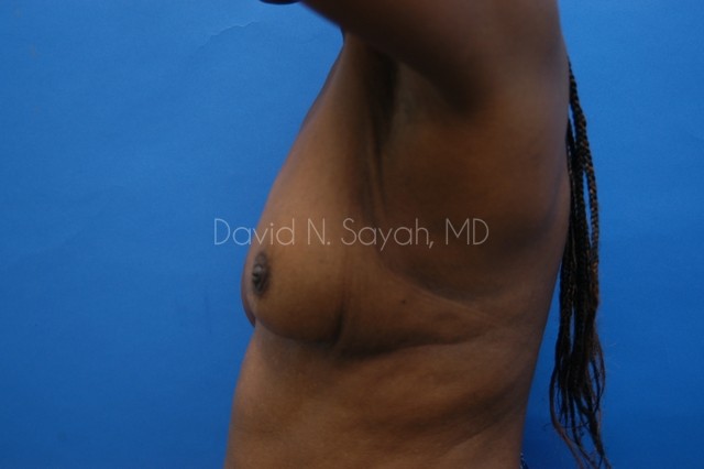 Breast Implant Exchange Before and After | Sayah Institute