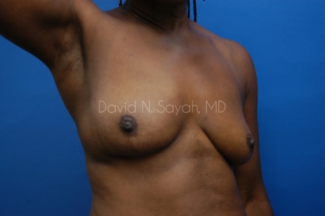 Breast Implant Exchange Before and After | Sayah Institute