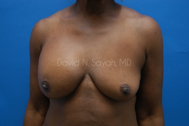 Breast Implant Exchange Before and After | Sayah Institute