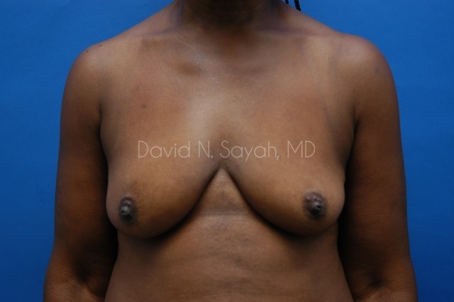 Breast Implant Exchange Before and After | Sayah Institute
