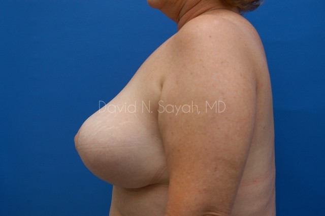 Breast Implant Exchange Before and After | Sayah Institute