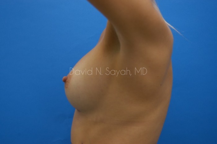 Breast Implant Revision Before and After | Sayah Institute
