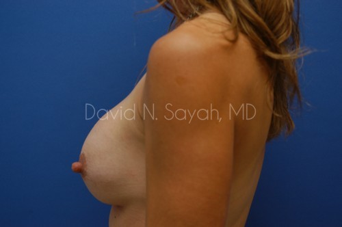 Breast Implant Revision Before and After | Sayah Institute