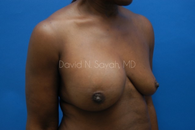 Breast Implant Revision Before and After | Sayah Institute