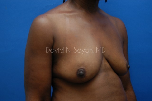 Breast Implant Revision Before and After | Sayah Institute
