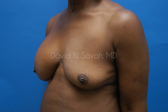Breast Implant Revision Before and After | Sayah Institute