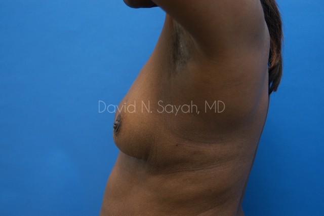 Breast Implant Revision Before and After | Sayah Institute