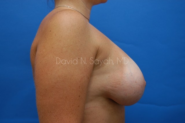 Breast Implant Revision Before and After | Sayah Institute
