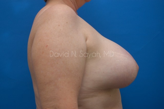 Breast Implant Revision Before and After | Sayah Institute