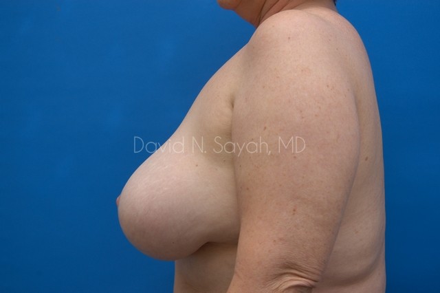 Breast Implant Revision Before and After | Sayah Institute
