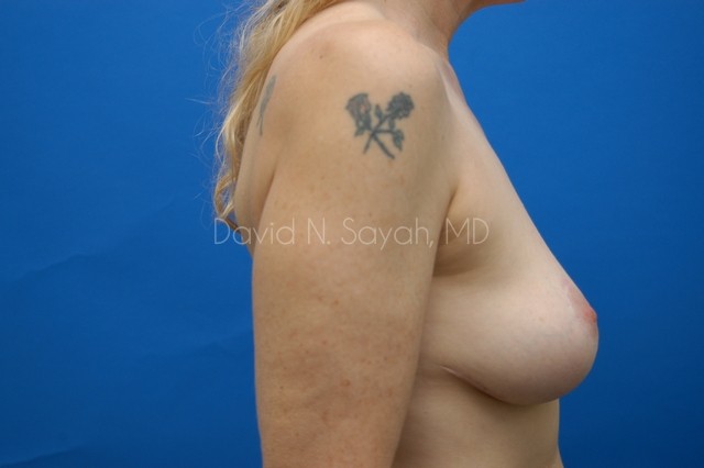 Breast Implant Revision Before and After | Sayah Institute