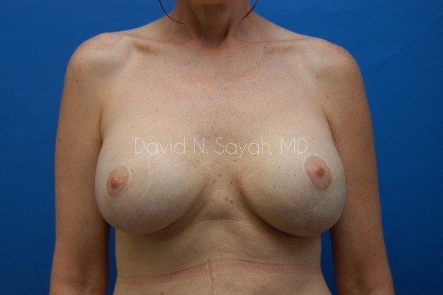 Breast Implant Revision Before and After | Sayah Institute