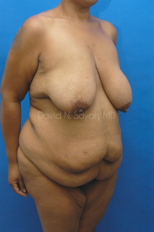 Breast Lift Before and After | Sayah Institute