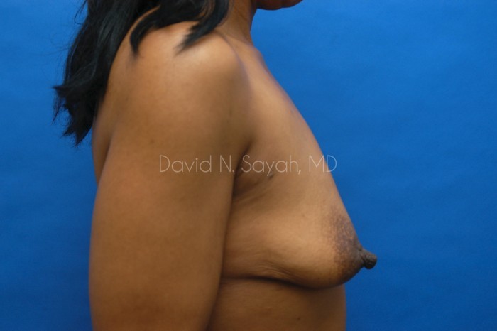 Breast Lift Before and After | Sayah Institute
