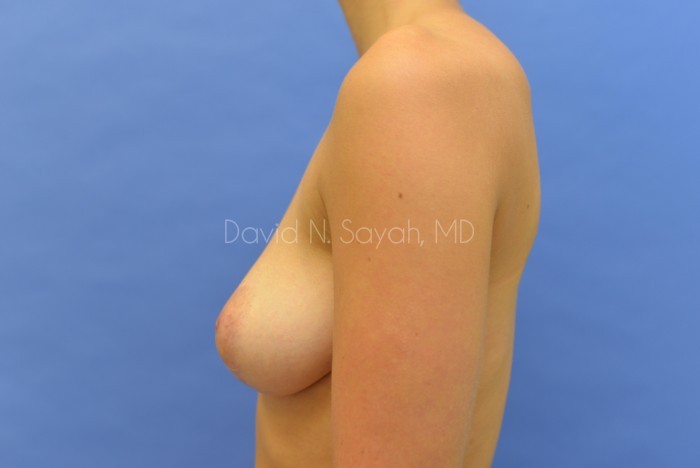 Breast Lift Before and After | Sayah Institute