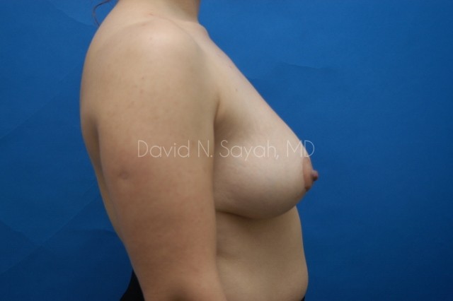 Breast Lift Before and After | Sayah Institute