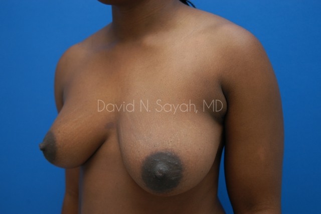 Breast Lift Before and After | Sayah Institute