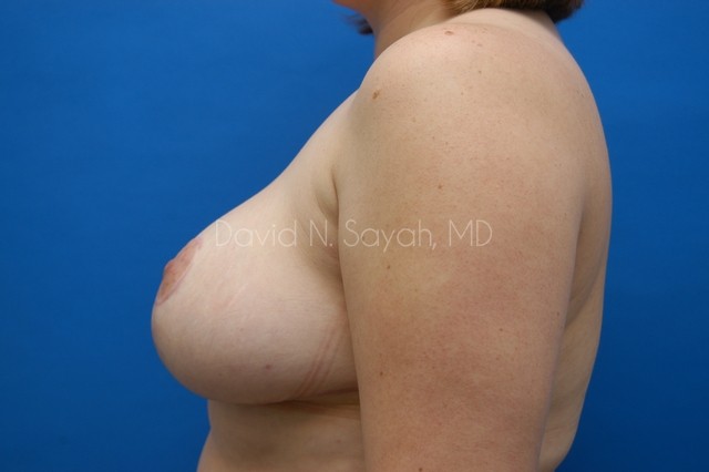 Breast Lift Before and After | Sayah Institute